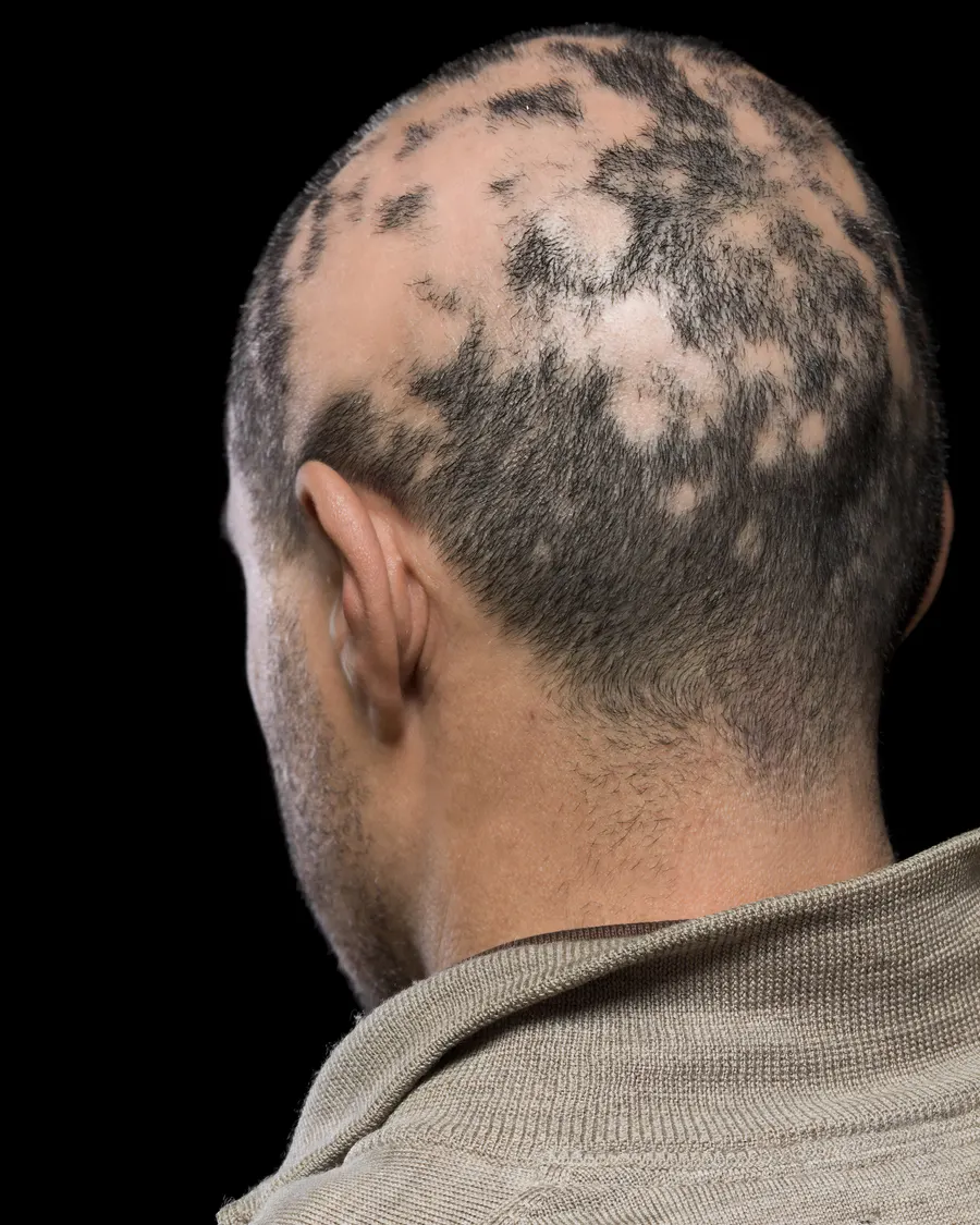 Advanced Alopecia Care at Cinch Clinics
